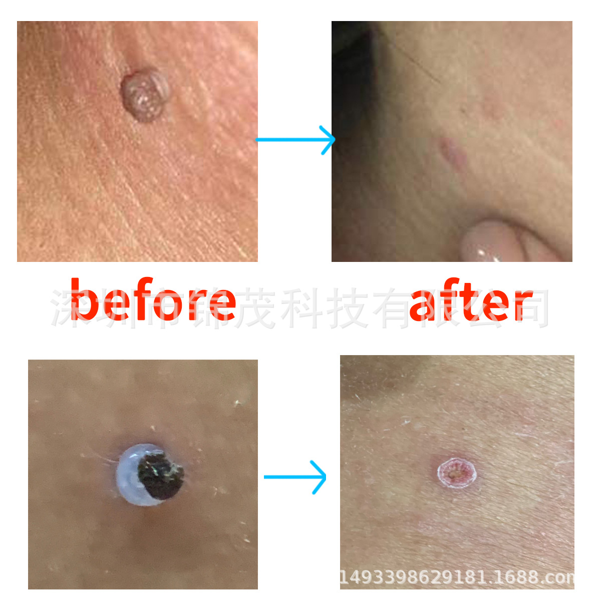 skin tag rubber band祛肉痣套装疣瘊皮肉赘肉猴收缩橡胶圈