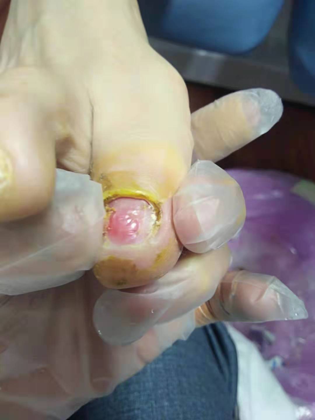 厂家货源灰指甲脱甲膏软甲膏脱甲冷敷凝胶量大从优