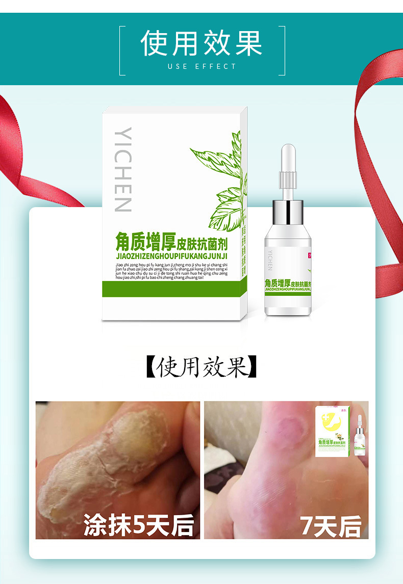 角质增厚皮肤抗菌剂oem/odm 去死皮老茧角质手足皮肤护理