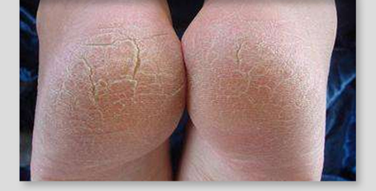 皲裂橡皮膏4米压敏棉布橡皮膏手脚防开裂胶带透气棉质护手指胶布