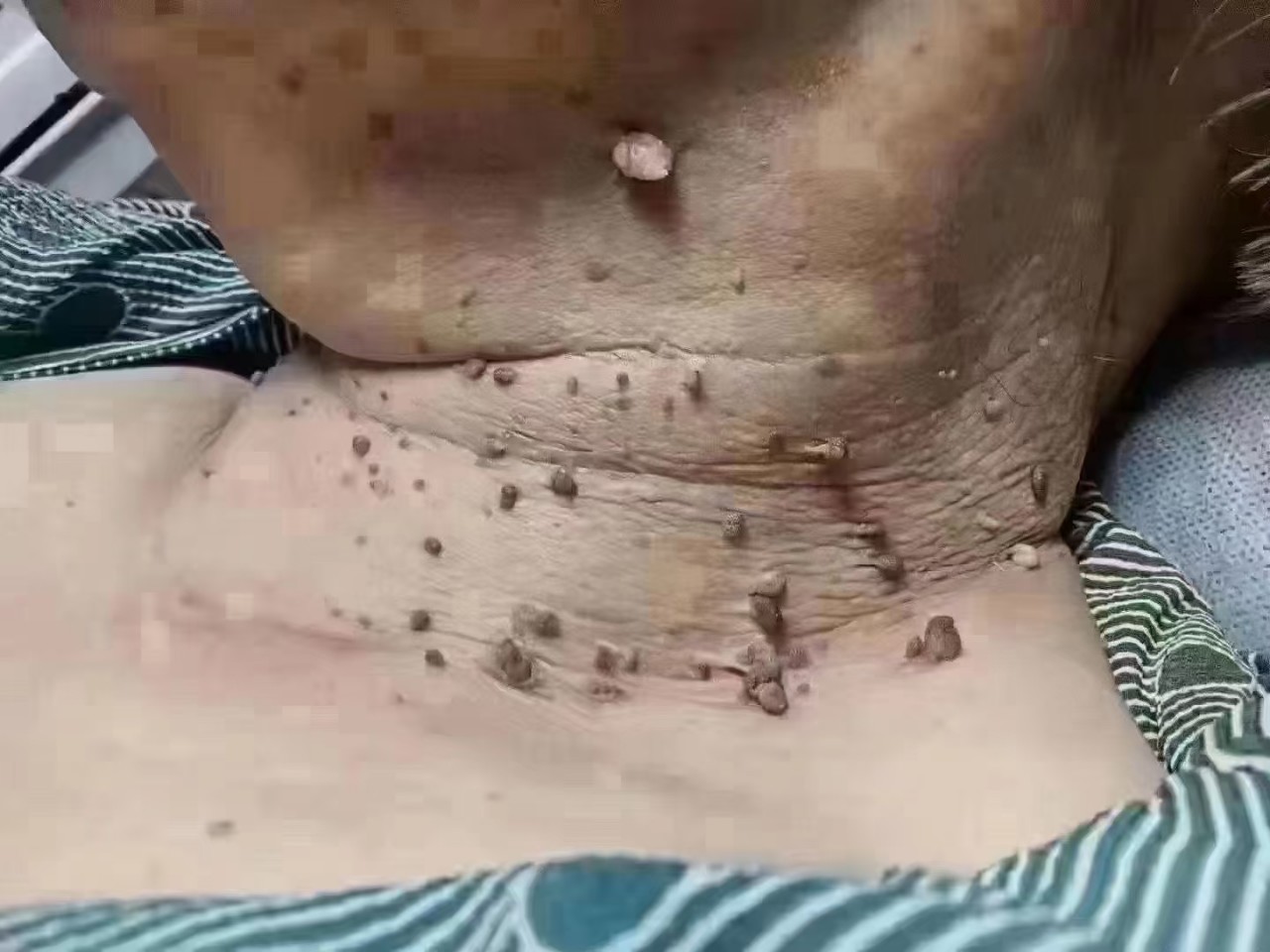 去除扁平尤腋下脖子小肉粒疙瘩丝状11疣小猴子跖11寻常11疣11瘊子