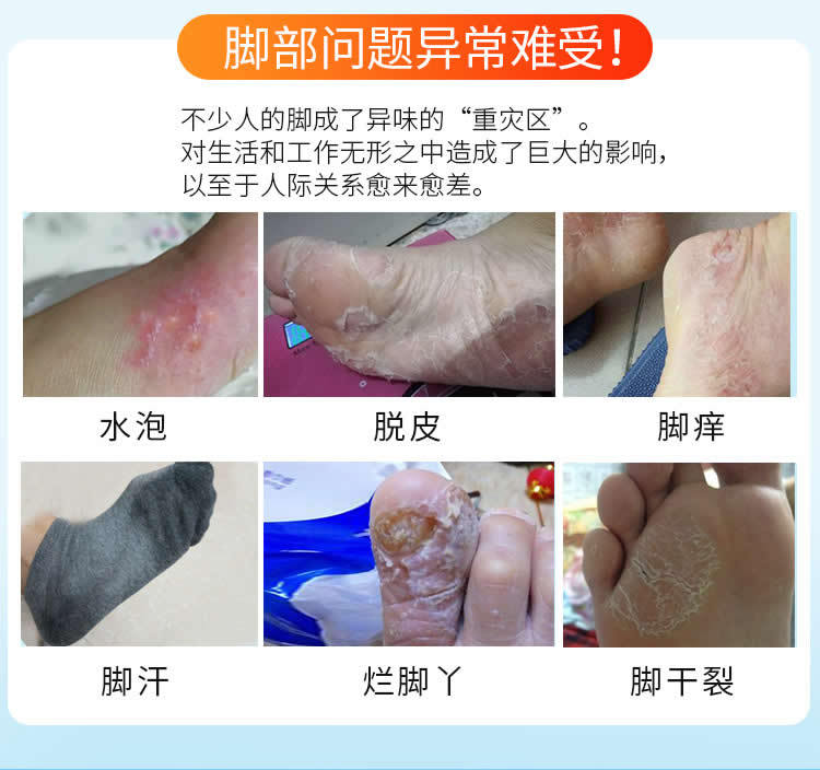 托嗳狼毒足爽套装狼毒喷剂止痒脱皮脚臭瘙痒皮肤软膏烂脚丫现货