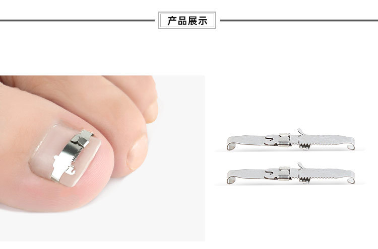 脚趾甲不锈钢夹扣向内生长脚趾甲工具趾甲嵌脚器拉伸脚趾矫形器