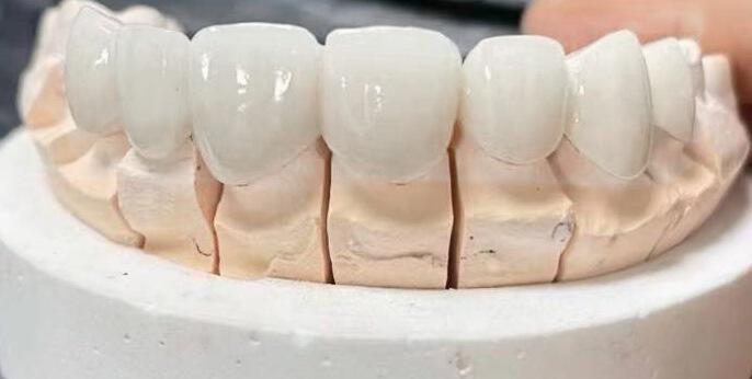 义齿美牙玻璃陶瓷  全瓷美牙贴面,牙贴厂家直销,技术培训包教会