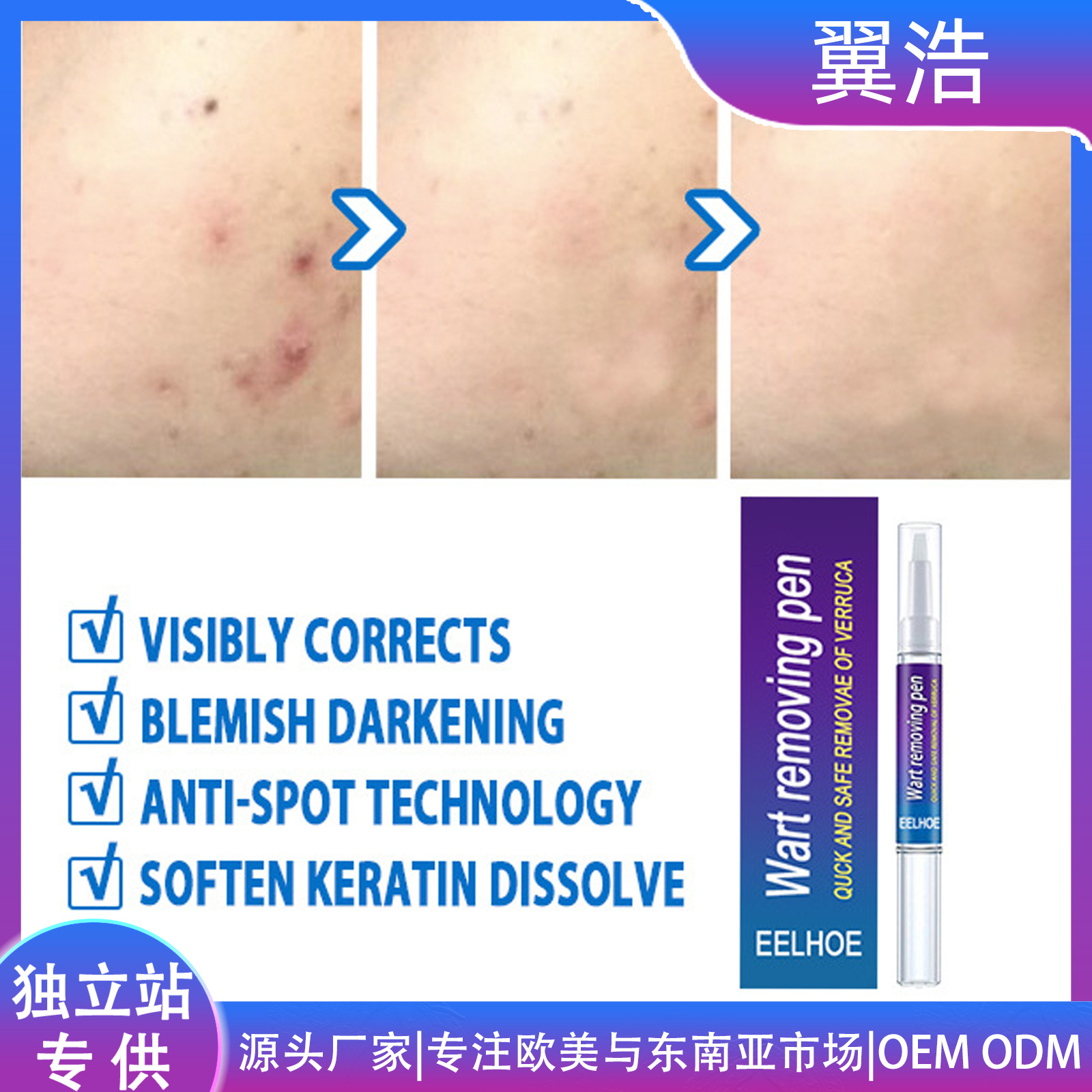 eelhoe 克疣液笔 克尤液笔皮肤优瘊平肉粒平拓疣点痣笔疣立净