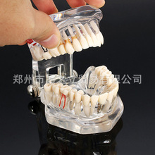 牙科修复模型 透明可拆卸病理种植牙模型 连桥模型 贴面 牙髓演示