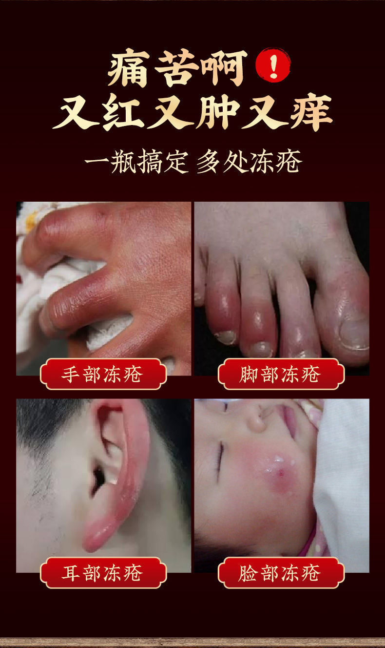 南京同仁堂冻疮膏修护止痒手脚耳朵护手霜防冻防裂皲裂脚裂开裂膏