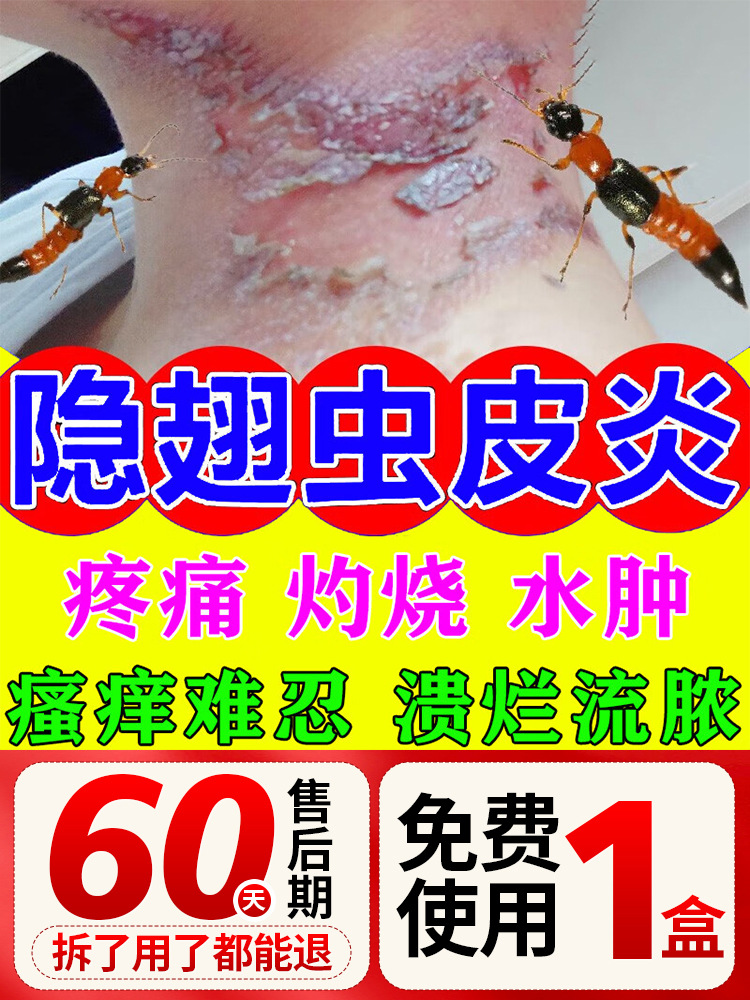 隐翅虫咬伤药膏红火蚂蚁咬伤跳蚤毒虫叮咬止瘙痒祛疤消肿外用药膏