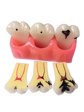 牙科模型 4倍龋齿演变分解模型 医患教学模型 龋齿演变模型 包邮