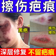 疤痕膏无痕淡化剖腹产妊娠纹孕纹增生烫伤烧伤手术痘坑疤痕霜批发