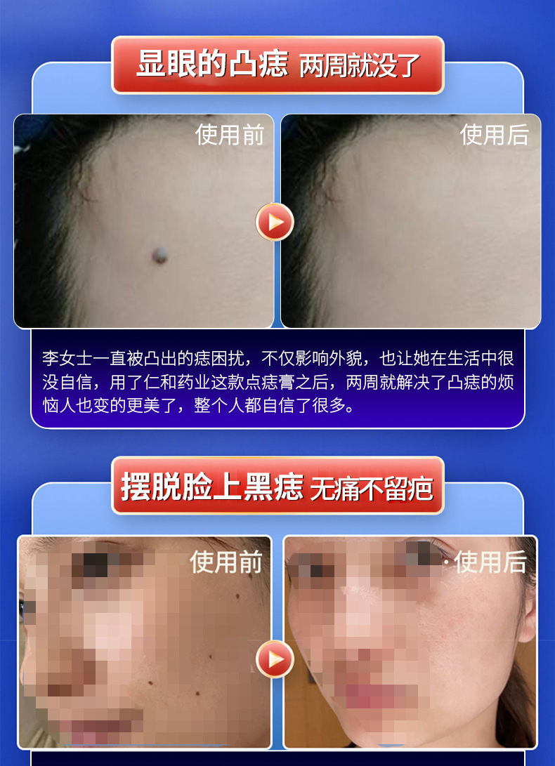 点痣膏植物古方点痣膏无痕药水痣刺猴肉痣黑点凸痣膏工厂院线专供