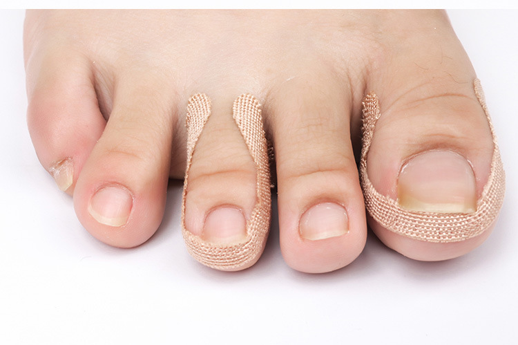 改善脚趾内嵌甲沟缓解贴纠正卷指甲无痛矫正贴脚趾嵌甲贴