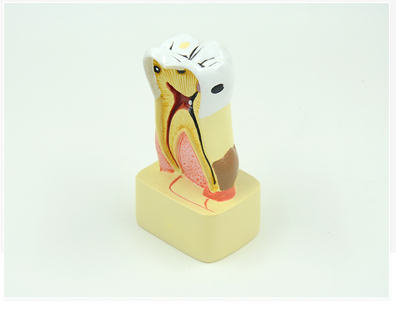 供应小病理牙齿模型幼儿园口腔教学玩具牙科医用教学口腔科病理