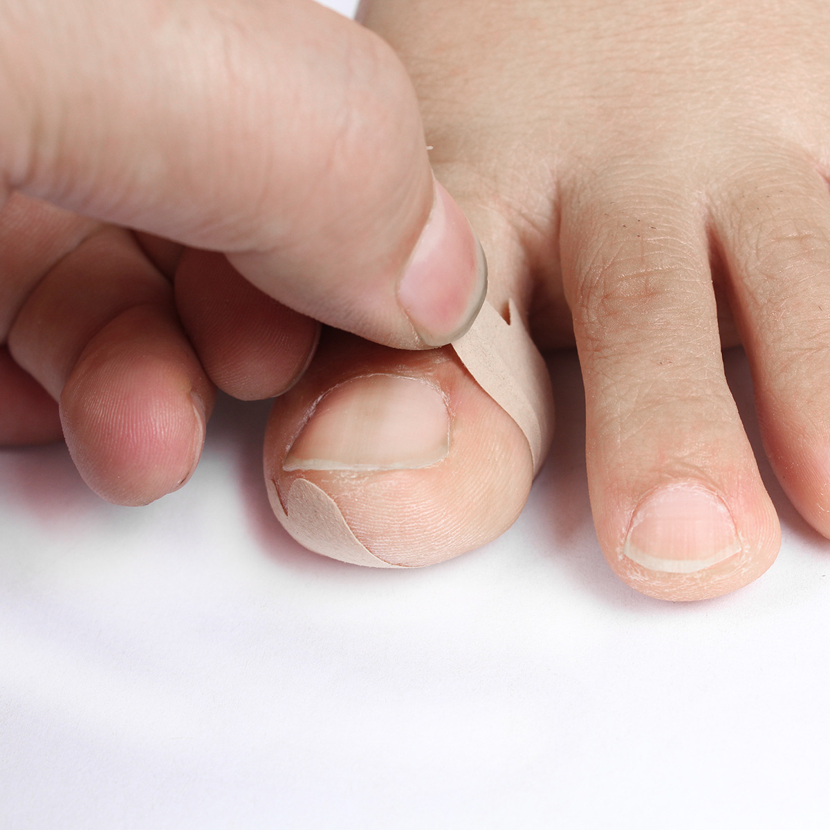 蝴蝶贴下拉式脚趾甲扎肉贴免胶水正甲贴嵌甲贴正甲垫正甲扣矫正器