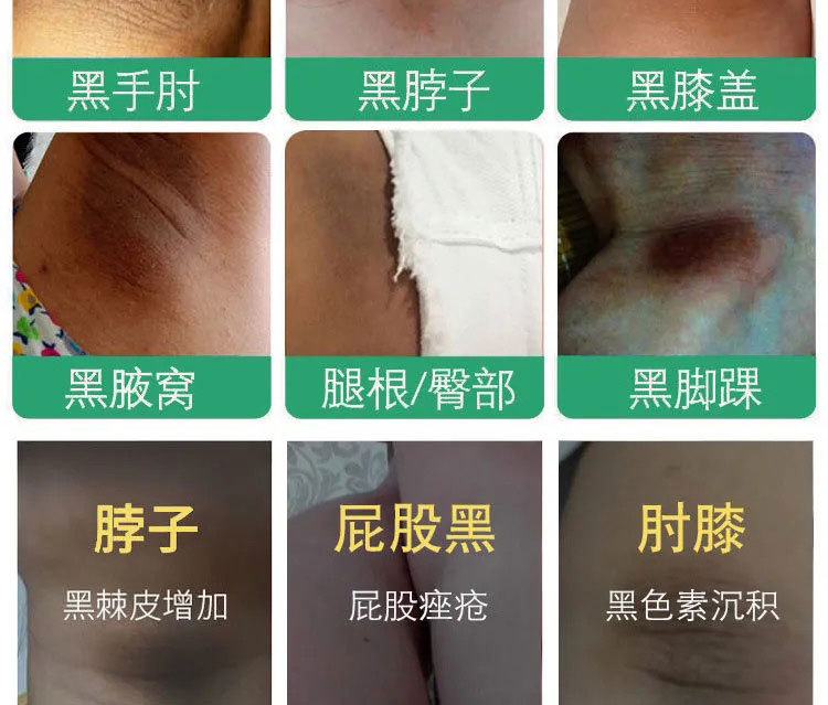 白愈腚乳膏关节手肘胳膊肘去黑死皮脖子腋下去黑色素脚踝膝盖变白