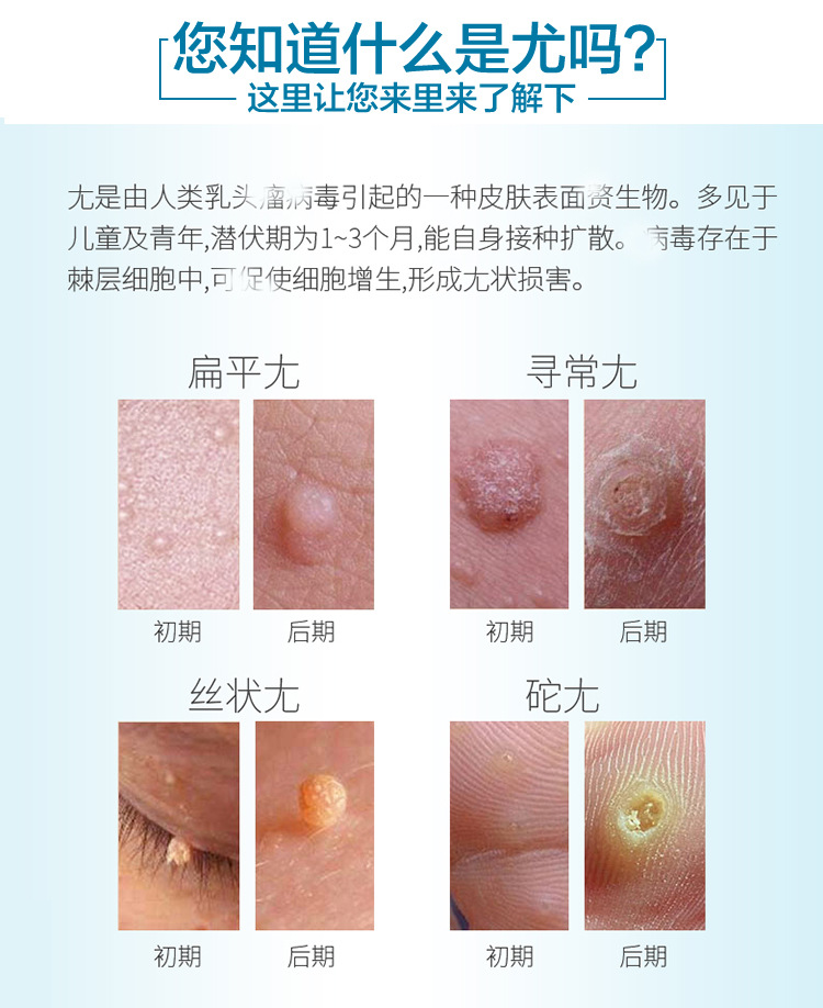 北京本草园研制疣瘊平 无腐蚀 qu除皮肤赘疣 内赠棉签5支