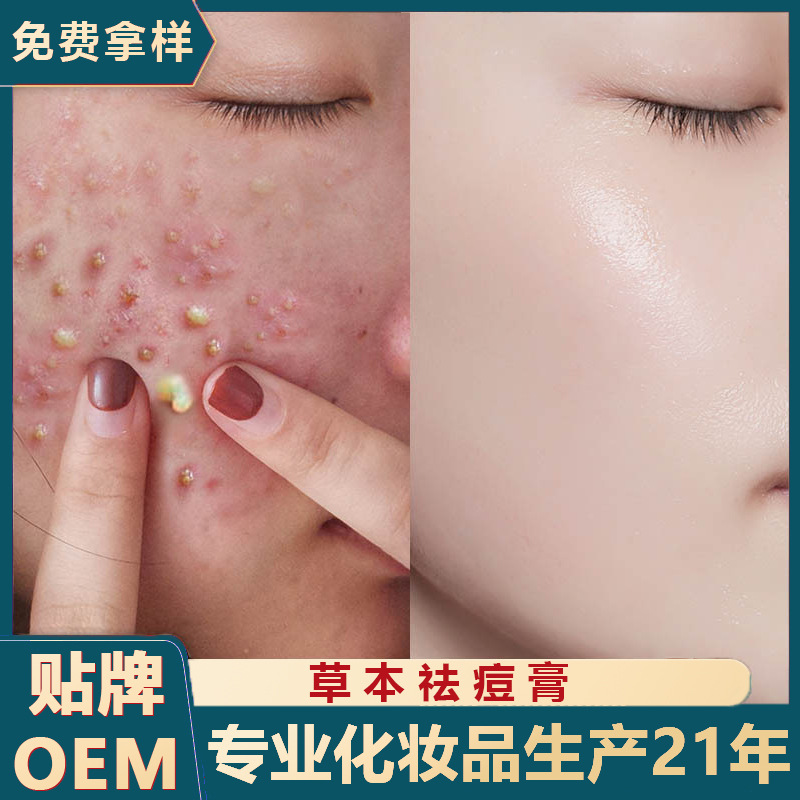 草本祛痘膏男女去青春痘闭口粉刺修护痘肌痘坑植物面霜美容院院线