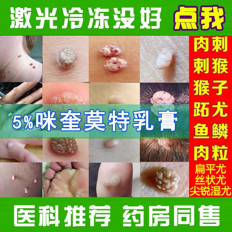 咪喹莫特乳膏软旗舰店正品5%丝状扁平疣专用克尤膏药去肉刺鱼鳞痣
