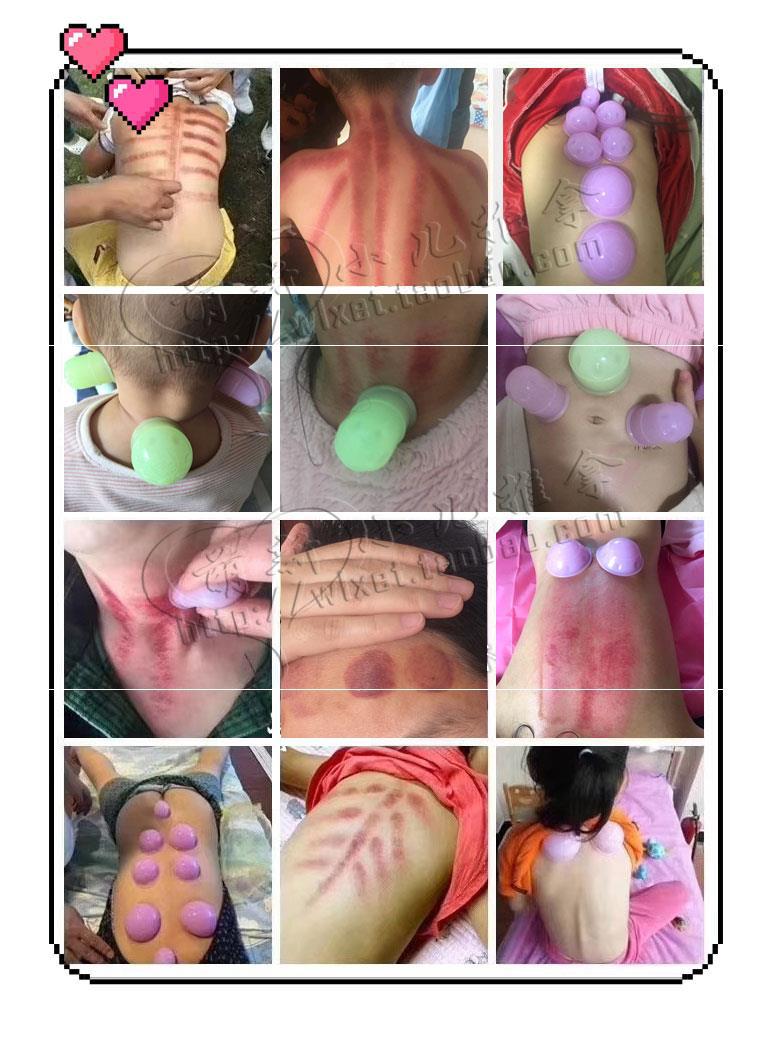 小儿脚底儿童刮痧神器吸痧一套走罐推拿花园刮痧器宝宝太极拔罐器