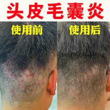 背上长痘痘后背药膏除螨虫专用疥疮人用胸前后面痘印