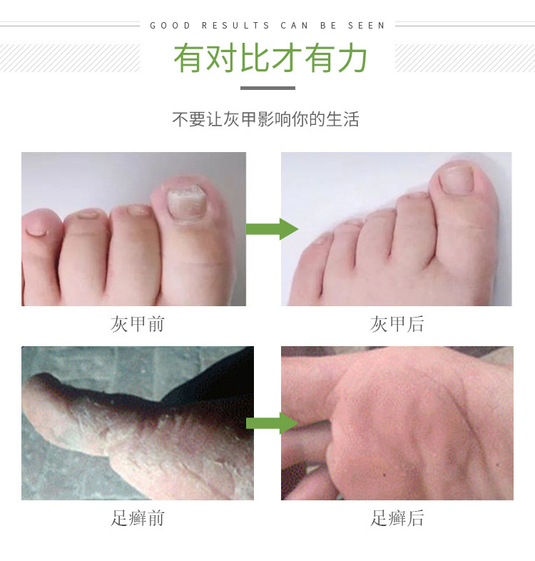 久木堂甲郎中灰甲液凹凸厚甲增厚型灰指甲软甲修护液