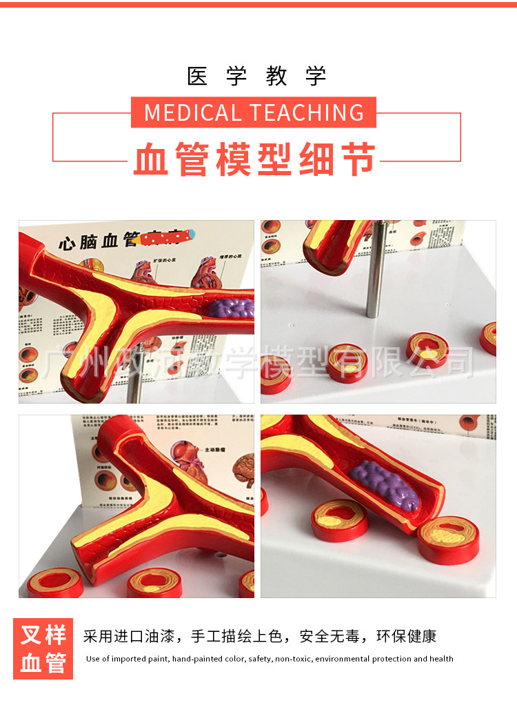 血管堵塞模型 血液浓度脂肪病理血液 血管粥样 血管病理解剖 模型
