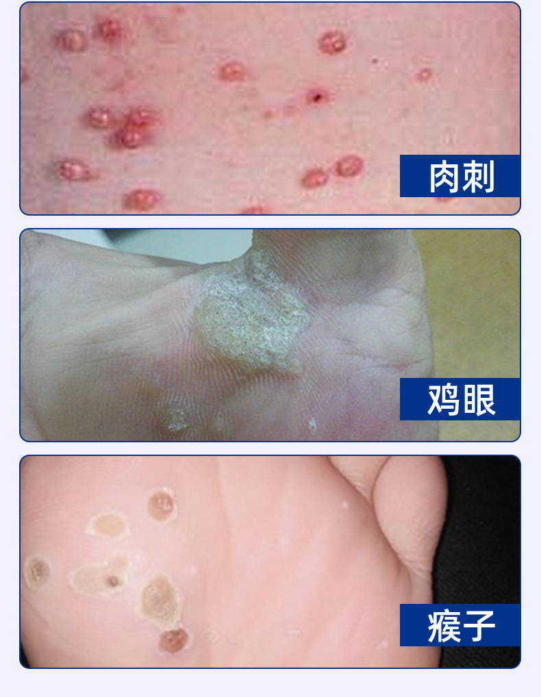 力克宁鸦胆子跖疣膏疣瘊子猴子净刺猴鸡眼趾正品肉粒疙瘩尤肉刺