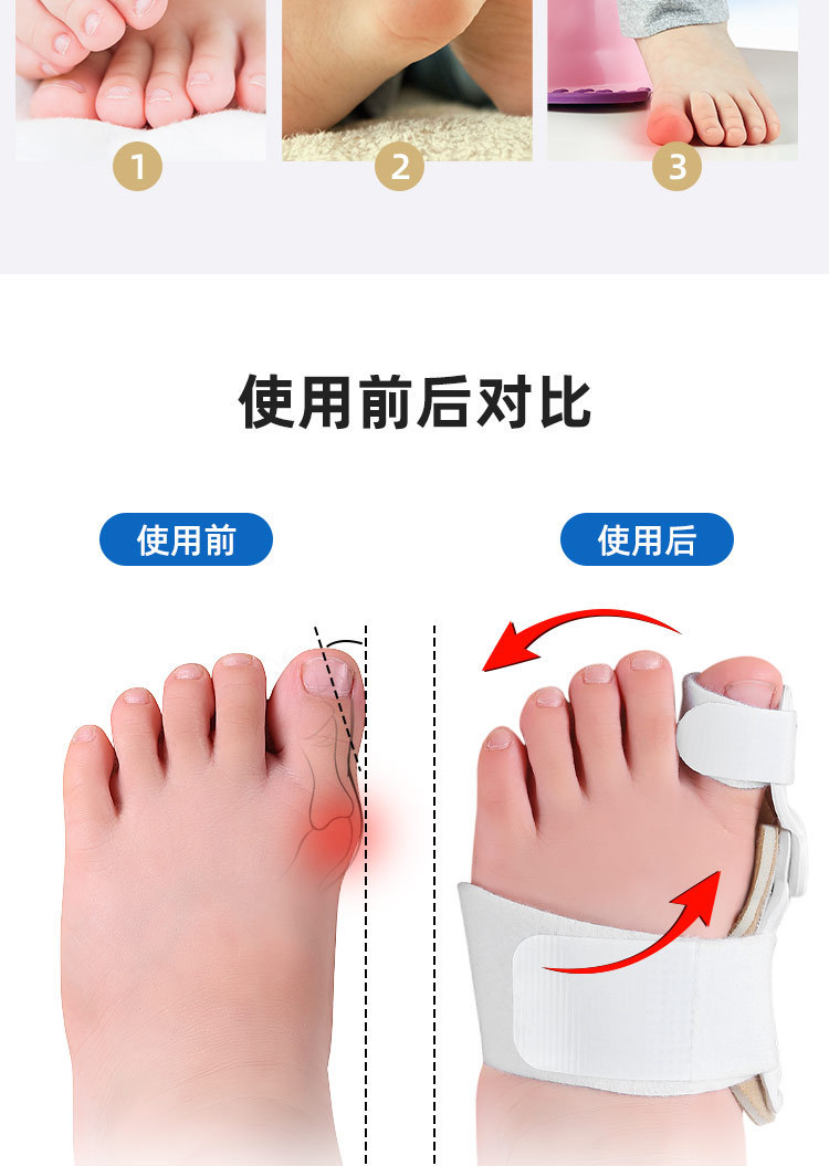儿童款拇趾外翻矫正器大脚趾重叠趾分趾器足外翻足部矫型器