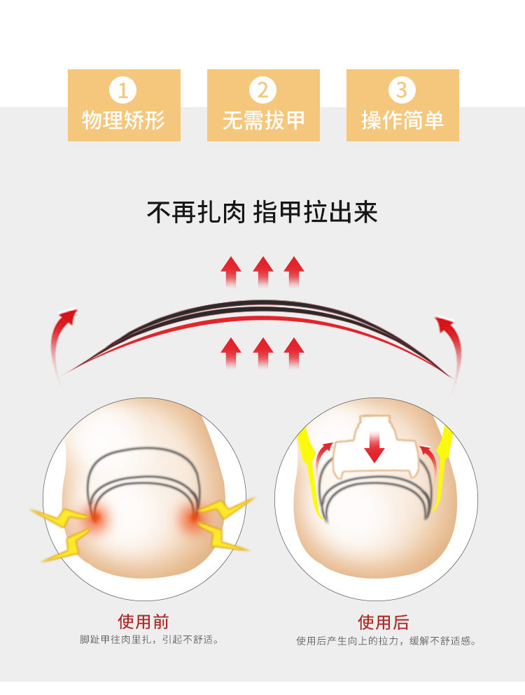 甲沟嵌甲矫正器脚趾甲长肉里正甲器卷甲嵌甲矫正工具套装
