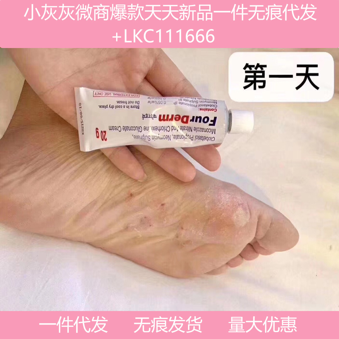 印度脚气膏20g体xian股xian脚痒脱皮起泡止痒软膏非常好