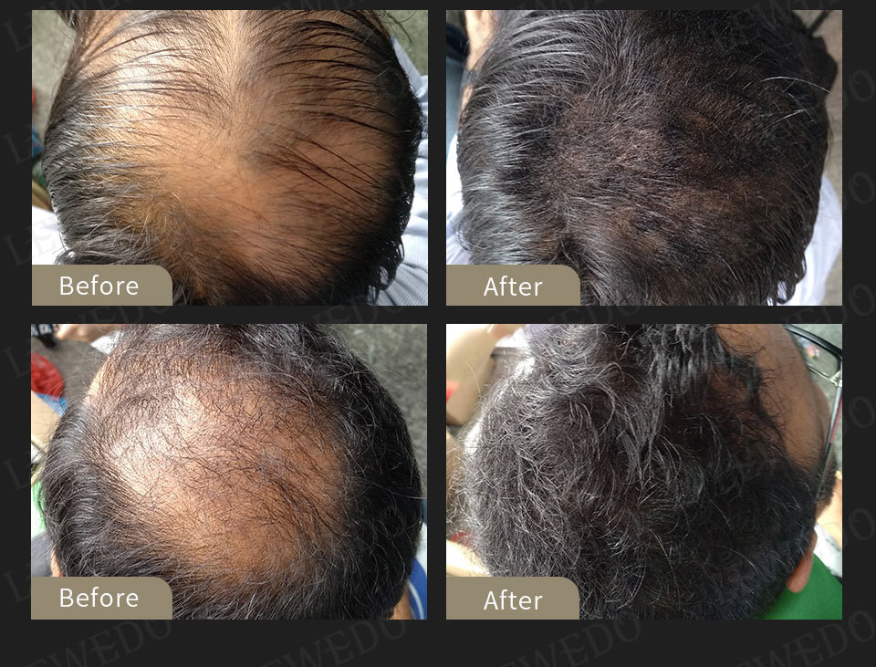 头发纤维粉一次性补发纤维25g 快速浓密纤维粉搭配梳子喷头定型水