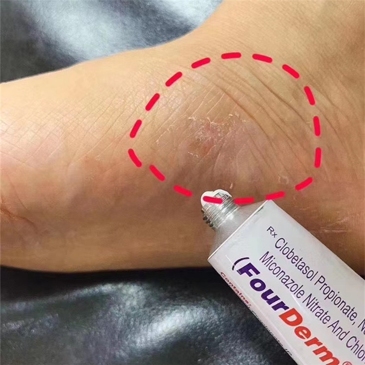 印度脚气膏20g脚痒脱皮起泡止痒软膏现货批发