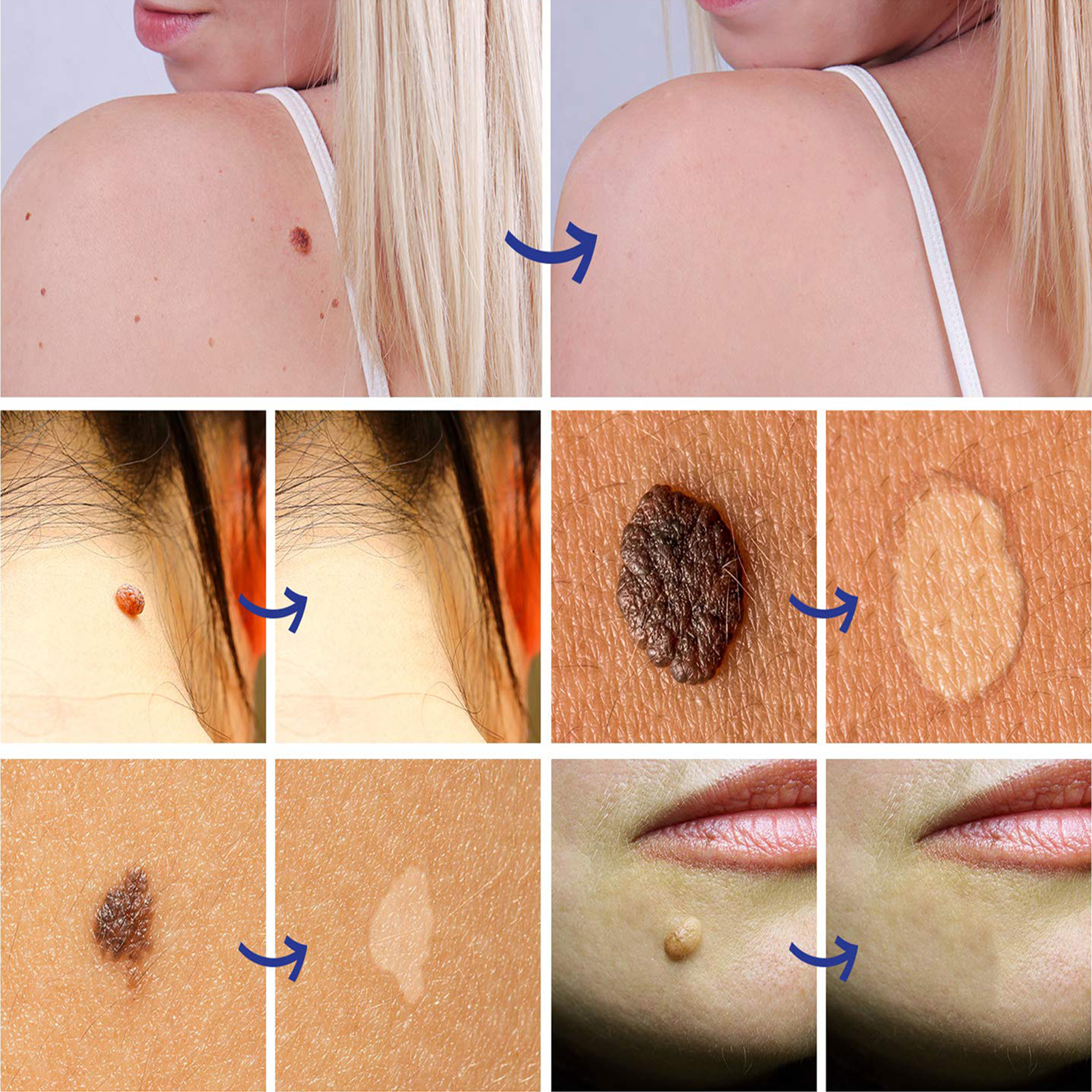 sefudun新品祛疣膏瘊疣平wart removal cream 鸡眼膏平常尤20g