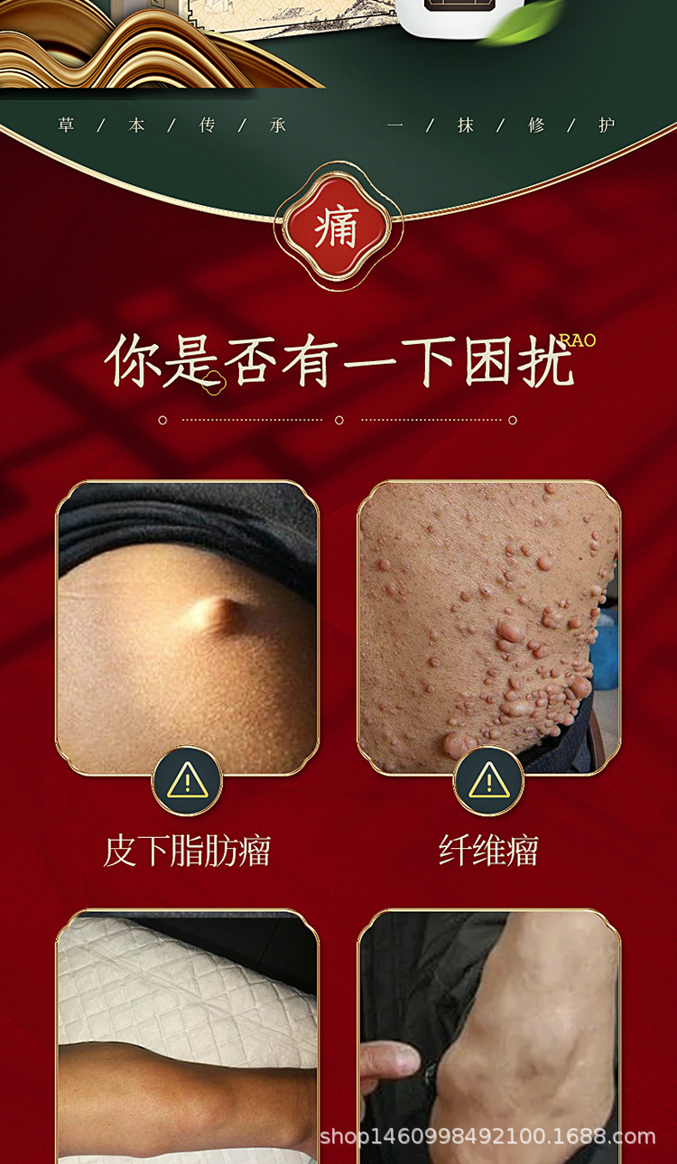 【官方】宿爱脂肪硬块膏乳膏50ml皮下结节硬块肿块脂肪硬块专用膏