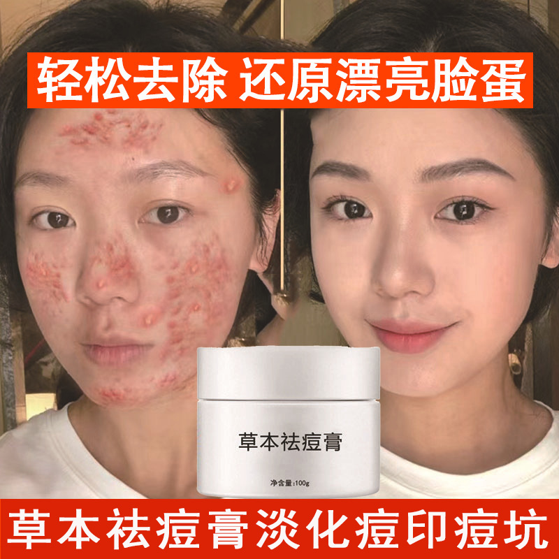 草本祛痘膏青春痘去粉刺痤疮去痘印痘坑收缩毛孔祛痘霜正品批发