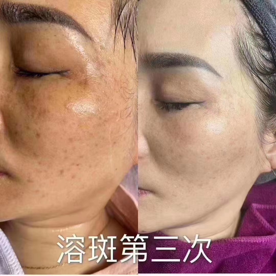 whitening溶斑冻干粉水分离淡化色素改善暗沉海绵微针后提亮肤色