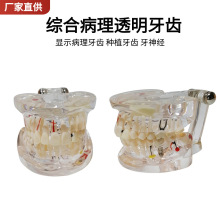 透明综合病理牙齿种植可拆卸神经牙模修复体全口病理医患沟通模型