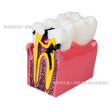 6倍龋齿模型 龋坏蛀牙/健康牙齿对比示范 口腔科 医患沟通模具