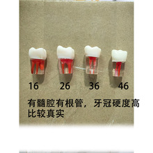 口腔牙科考试练习牙体牙髓透明根管预备充填修复根管模型