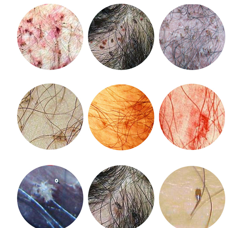 诗莱格虱子虱子喷剂 虱卵头发成人儿童头虱 一件代发源头厂家