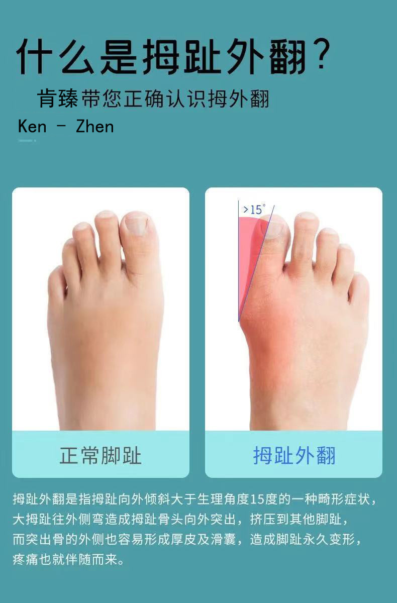 拇指外翻矫正器硅胶脚趾分离器脚趾头纠正大脚骨可穿鞋男女士日用