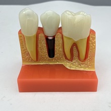 牙齿口腔教学模型四倍种植体模型牙科可拆卸 义齿连桥冠烤瓷修复
