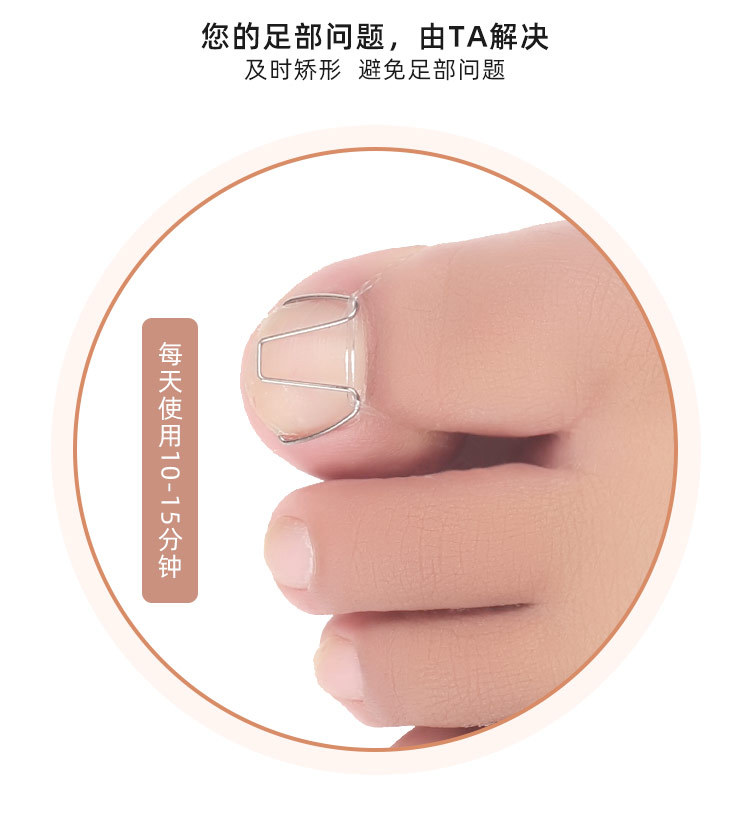 正甲丝甲沟嵌甲矫形器甲沟指甲往肉里长矫形正丝脚趾甲正甲钩