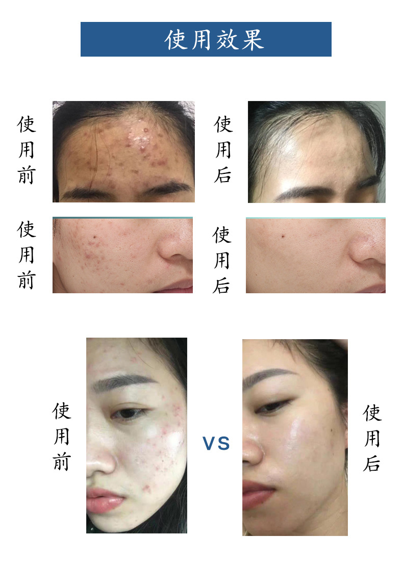 海绵微针 粉骨针粉修护痘坑去粉刺海藻矽针藻针美容院