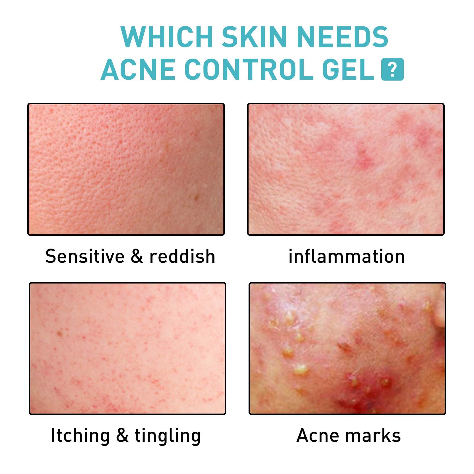 Jayusing Acne Repair Gel Smallpox Diluting Acne Spots Skin Repair Moisture Replenishment Brightening Skin