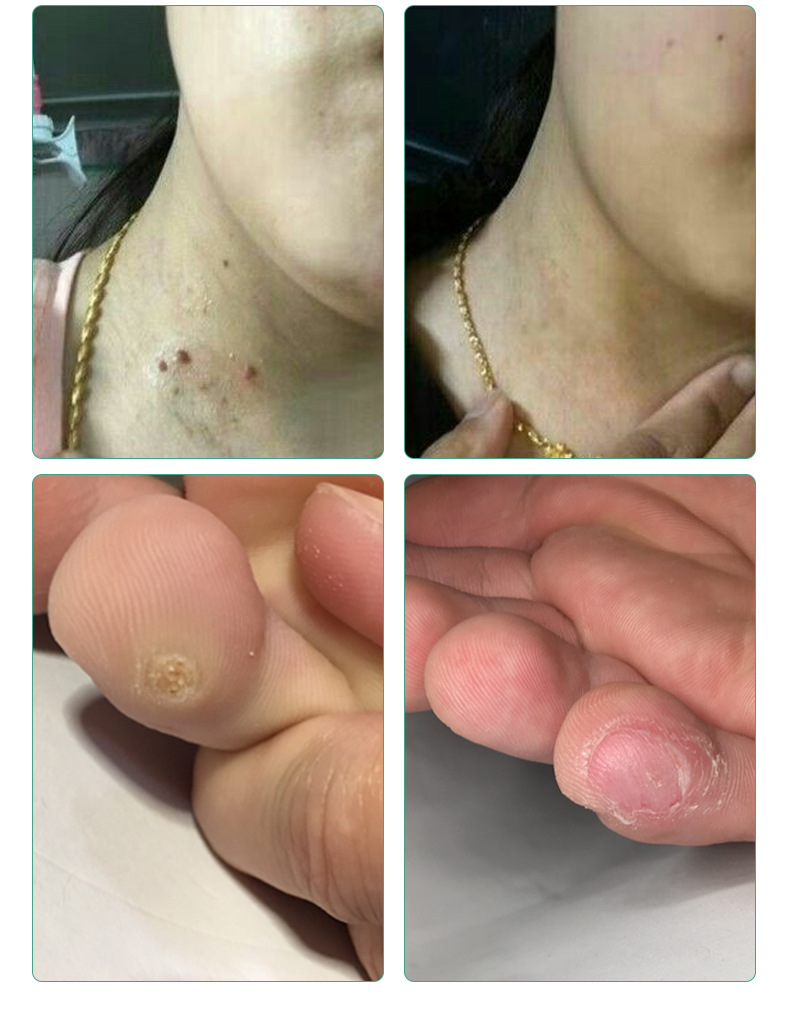 青原山鸦胆子克疣液丝状疣颈部头部瘊子去除克优净克尤液猴子肉粒