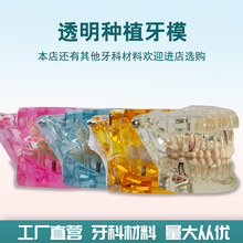 牙科种植体修复模型口腔教学模型医患沟通模型综合模型可拆卸牙模