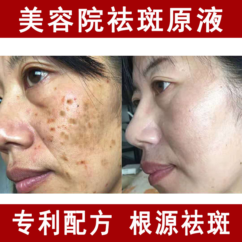熊果苷祛斑原液 美白祛黄褐斑去真皮斑377次抛美容院vc祛斑精华液