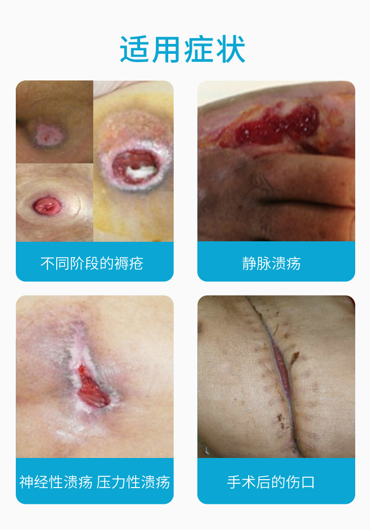 佳夫卡瑞褥疮贴聚氨酯泡沫敷料医用敷贴老人防压疮贴伤口无边10cm