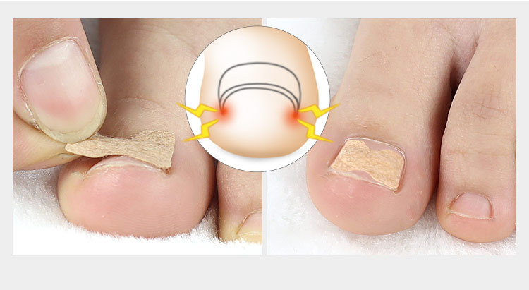 免胶水正甲贴脚趾甲甲沟嵌甲矫正器炎脚趾甲贴片拉拉修指甲专用